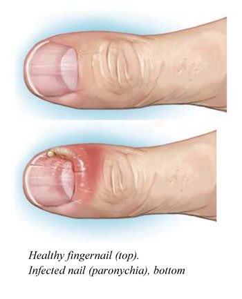 Nail Infection (Paronychia) Nail Infection (Paronychia)